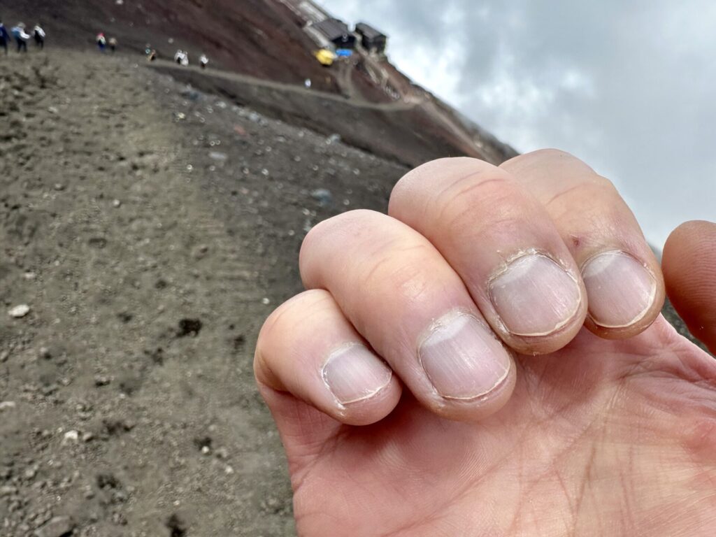 　富士山頂で高山病の症状、指先が真っ青に