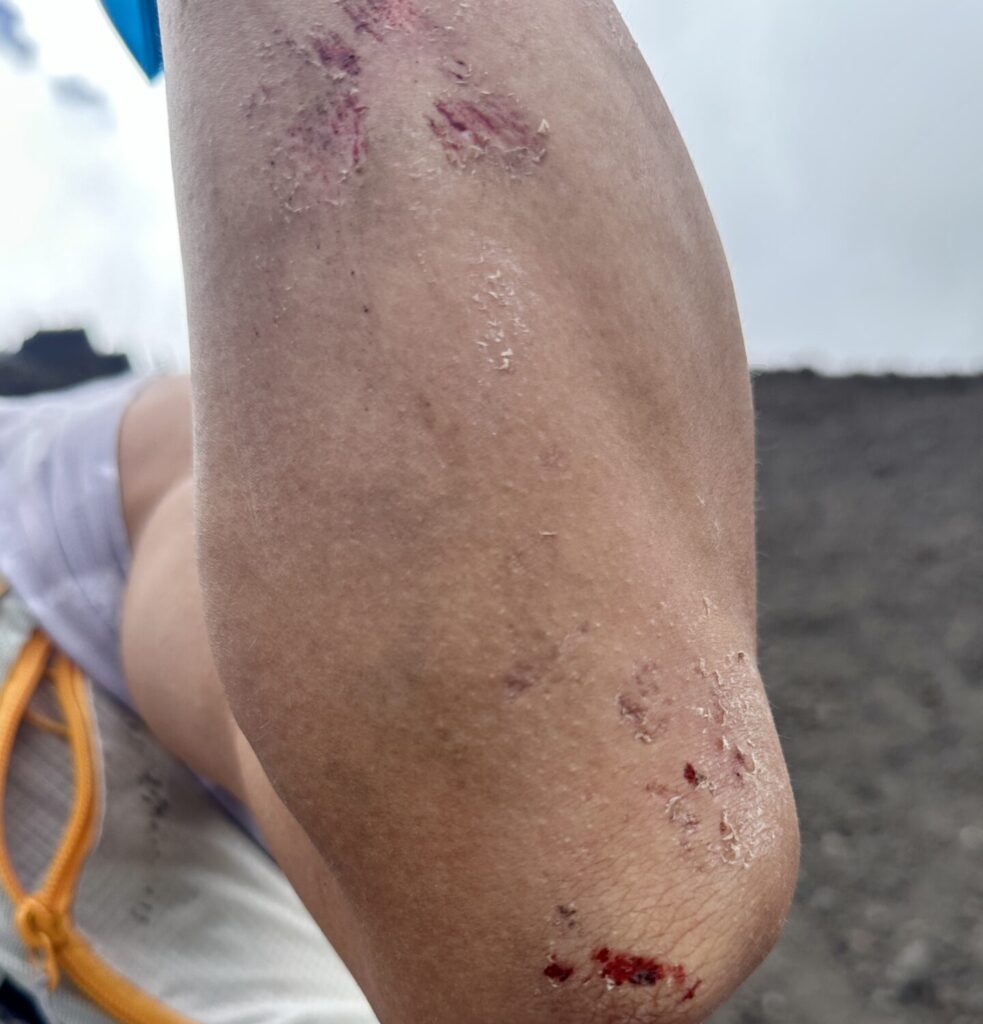 富士登山競走の試走、下山で転倒