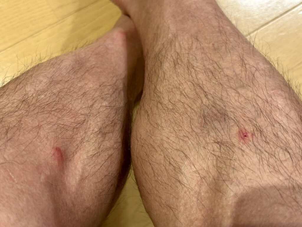 富士登山競走スタート前にぶよに刺される